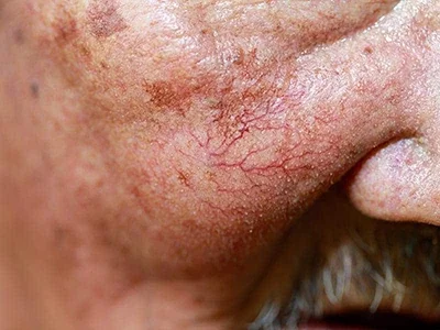 Kent Clinic Skin Condition 9